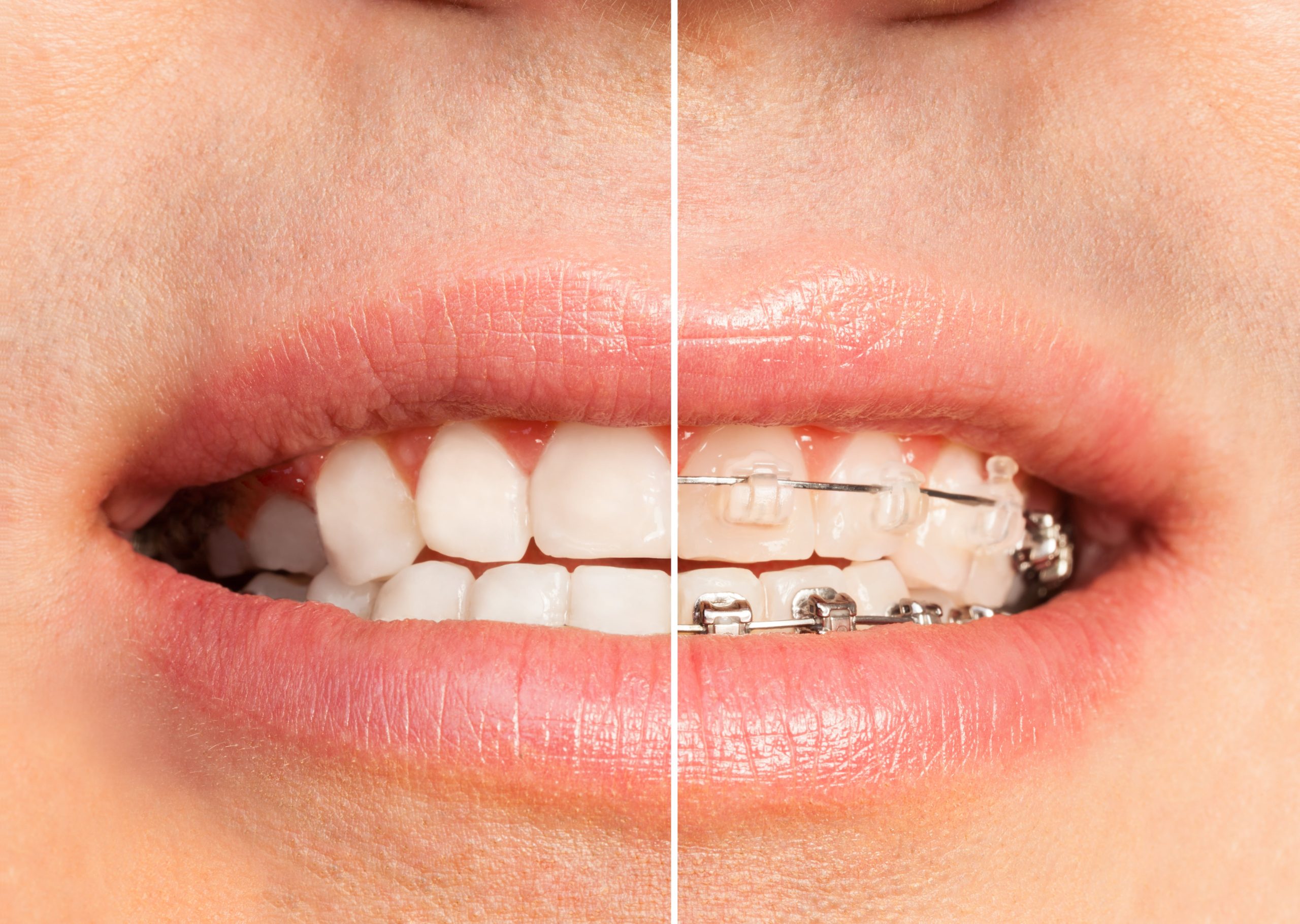 Compare Ceramic Braces and Clear Aligners: Which One is Right for You? -  Teeth Straightening London