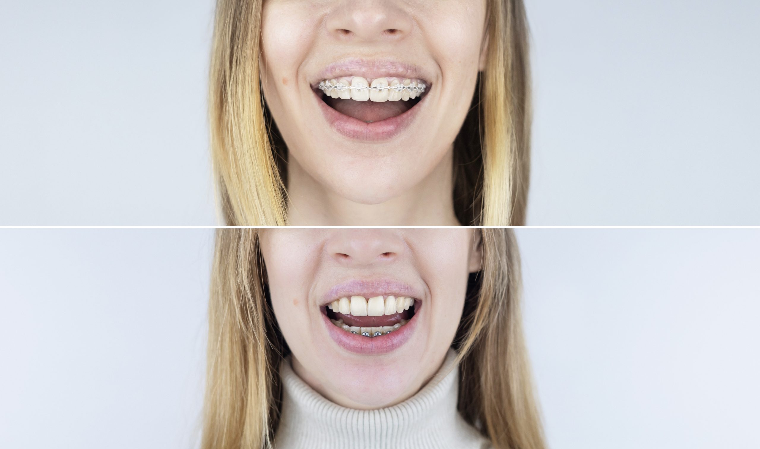 What is the best option for straightening your teeth: lingual braces or clear aligners?