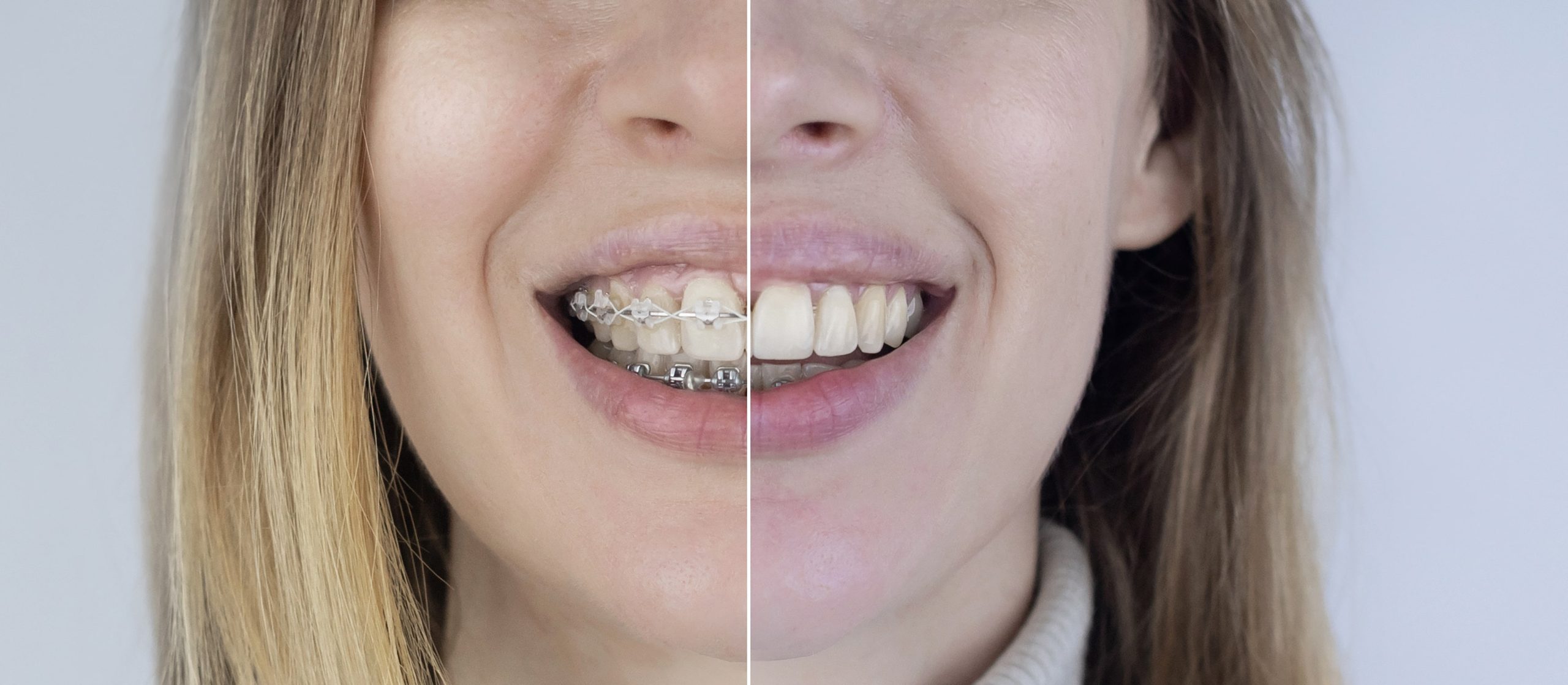 Metal vs Ceramic Braces: Which is the Best Option for You?