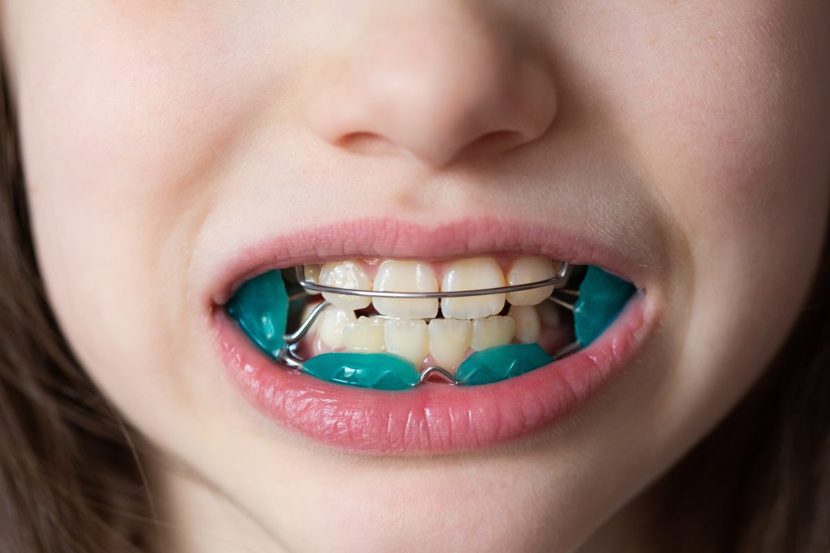 Orthodontic Solutions for London's Youngsters